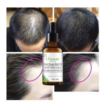 Anticaída Cabello Aceite , Alopecia Calvicie